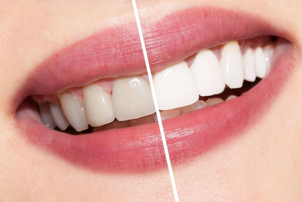 teeth-whitening-1024x686